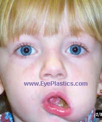 This causes the eyelid to open (increase in the palbebral fissure) with movements of the mouth